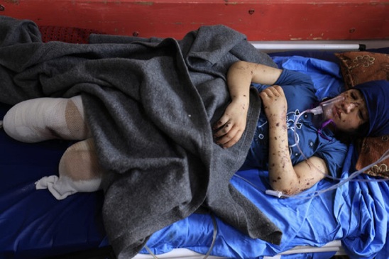 Image: «Πού είναι το πόδι μου;»: Συγκλονίζουν τα ακρωτηριασμένα παιδιά στην εμπόλεμη Γάζα